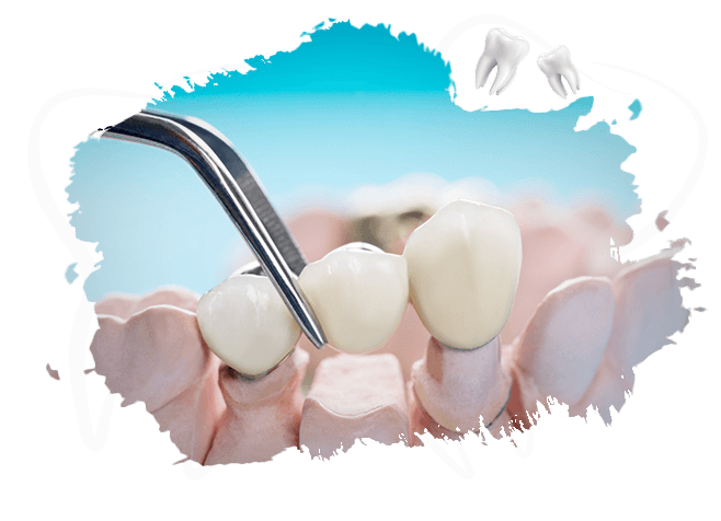 Bridge Ou implant Avantages Et Inconvénients