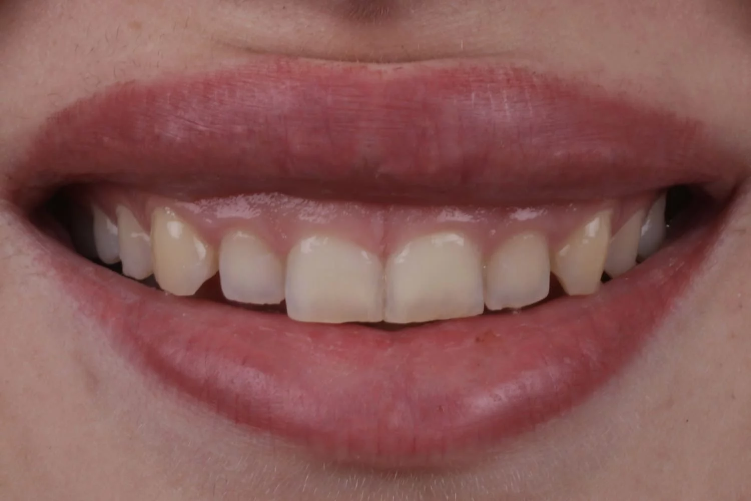 Anasayfa 16 emax dental before