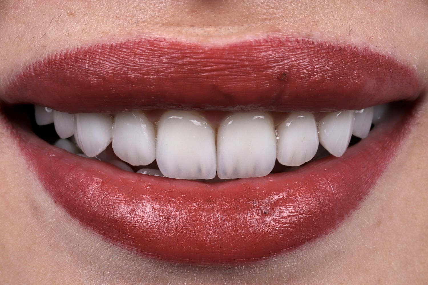 Diş Estetiği Uygulamaları Öncesi & Sonrası 9 E-Max Laminate Veneers-after