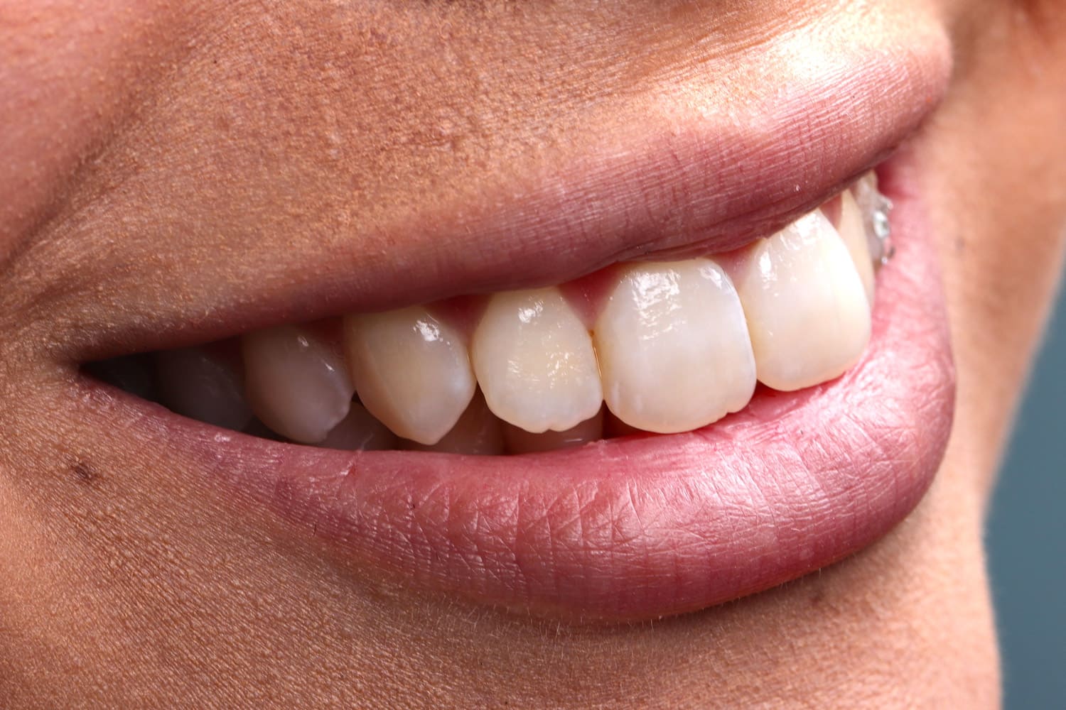 Diş Estetiği Uygulamaları Öncesi & Sonrası 6 E-Max Laminate Veneers-before