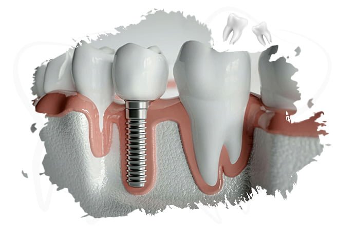 dental implant - diş implantı