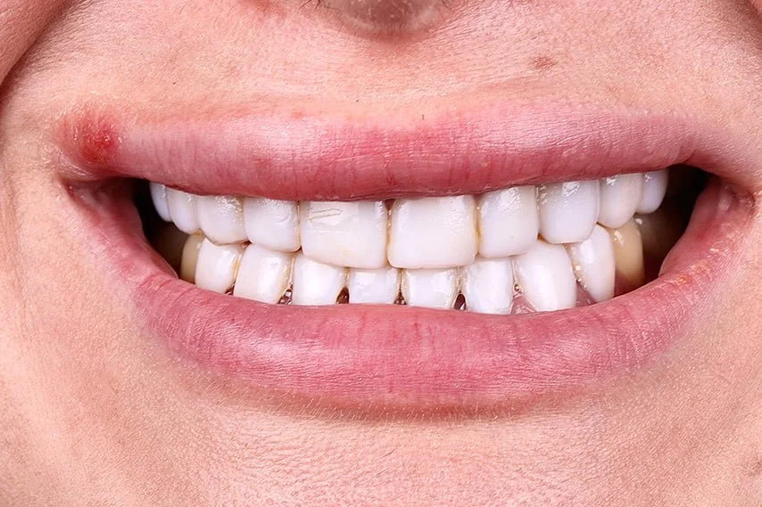 Anasayfa 14 minimal prep oncesi