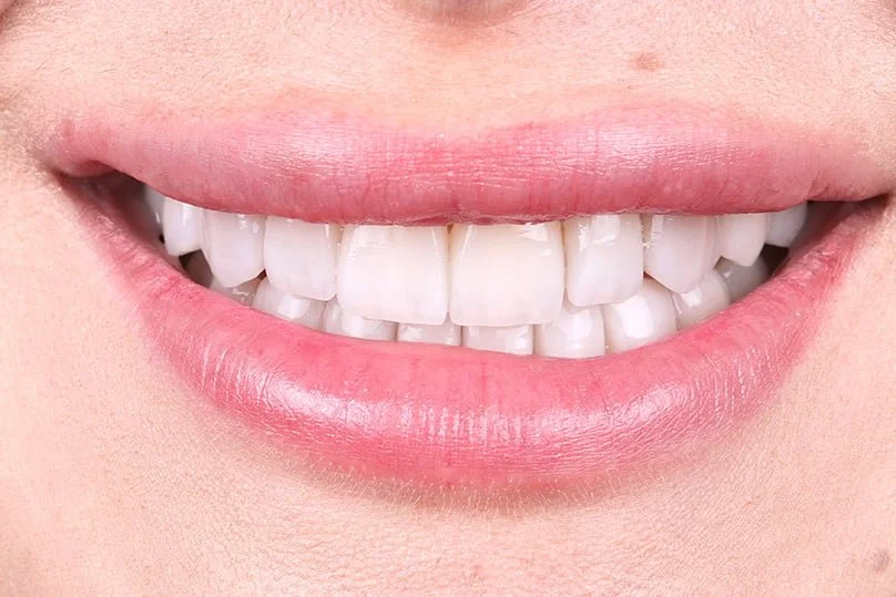 minimal prep sonrasi