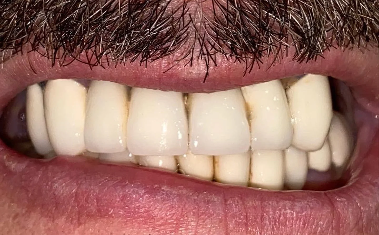 Beofre All on Four Implant
