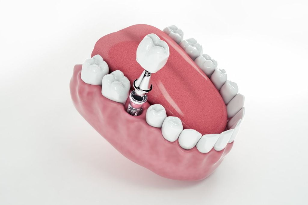 implant boyutu nedir