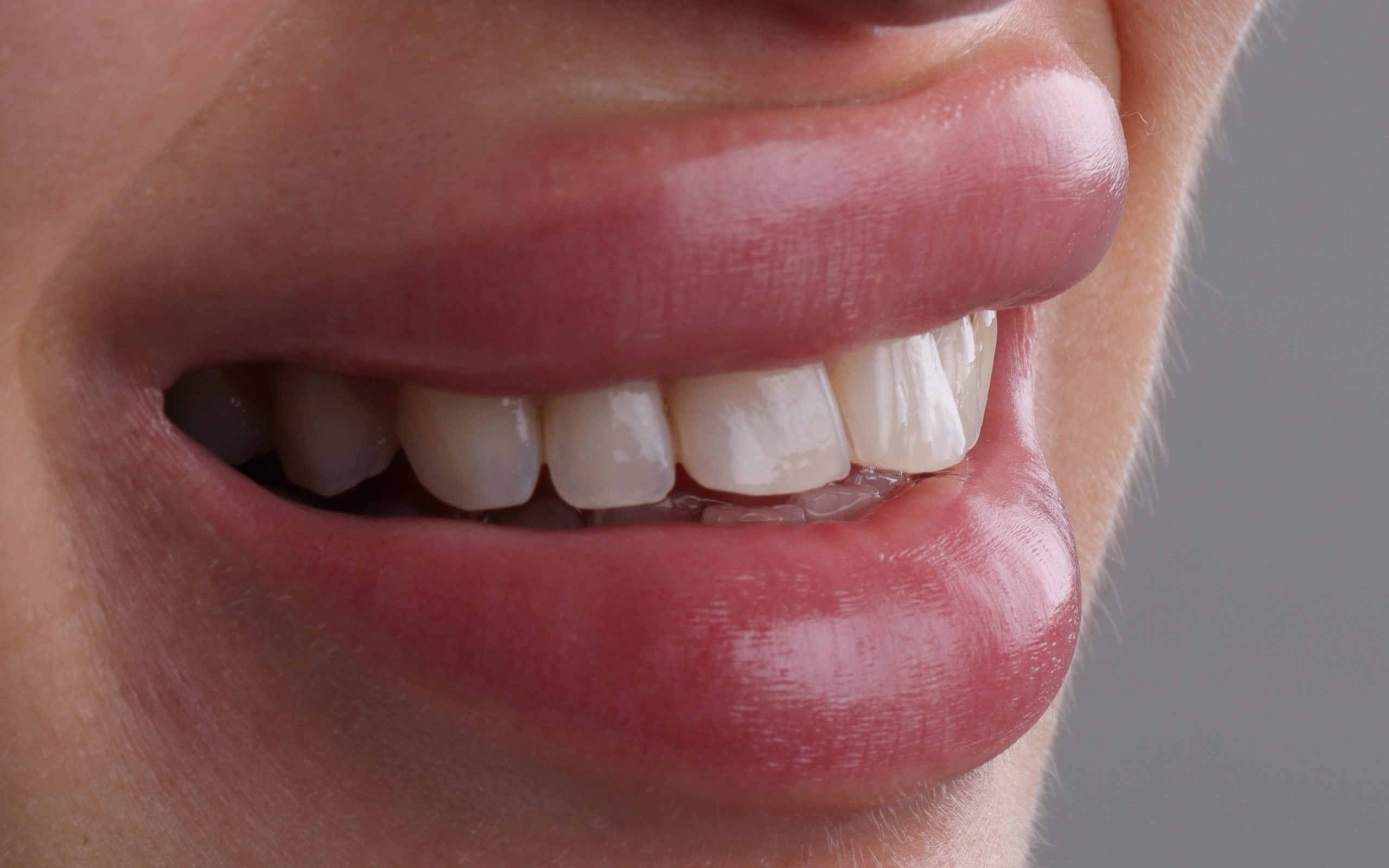 قبل وبعد تطبيقات تجميل الأسنان 52 diş beyazlatma