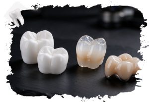 Zirconia, glass-ceramic and porcelain-fused-to-metal dental crowns side by side