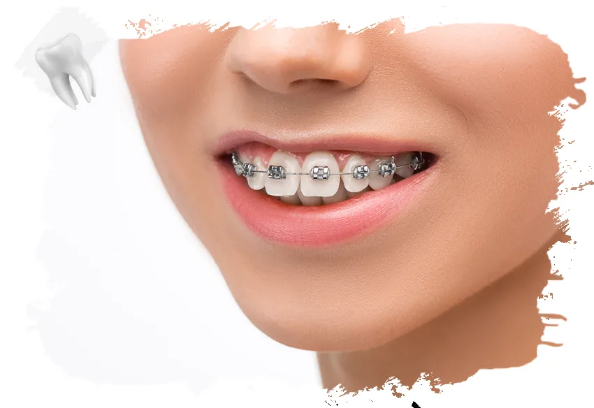 Invisalign