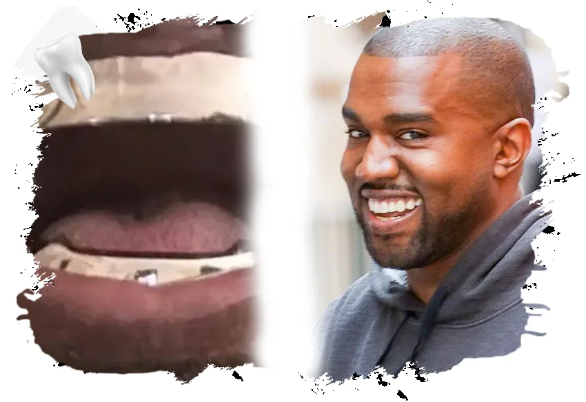 Pourquoi Kanye West a-t-il eu recours à un traitement en titane pour ses dents ? 2 Kanye West Dişleri