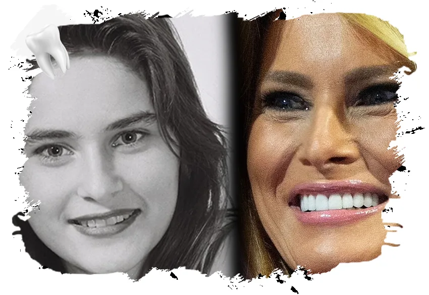 Is There Aesthetic Intervention for Melania Trump Teeth? 2 Genç Melania Trump