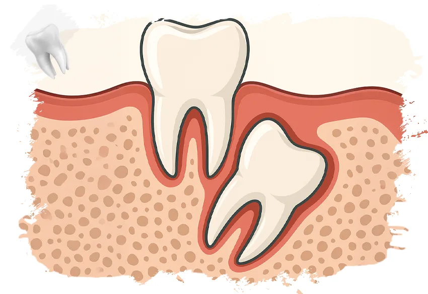 Impacted Tooth