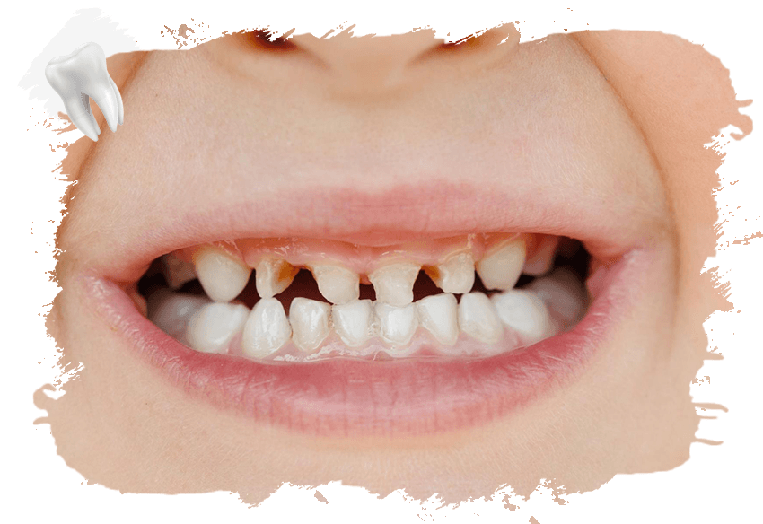 Perte de la Papille Interdentaire (Triangle Noir) : Causes et Comment Elle est Corrigée? 13 Diş Aracası Papilla Kaybı (Black Triangle)