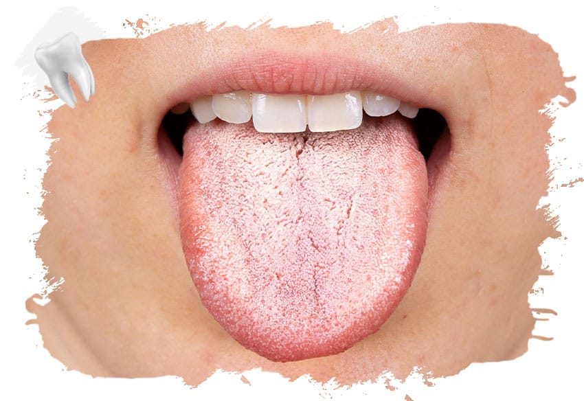 Dil Üstünde Beyazlık Nedir