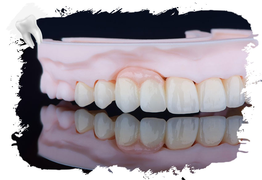 Diş Köprüsü Nedir?