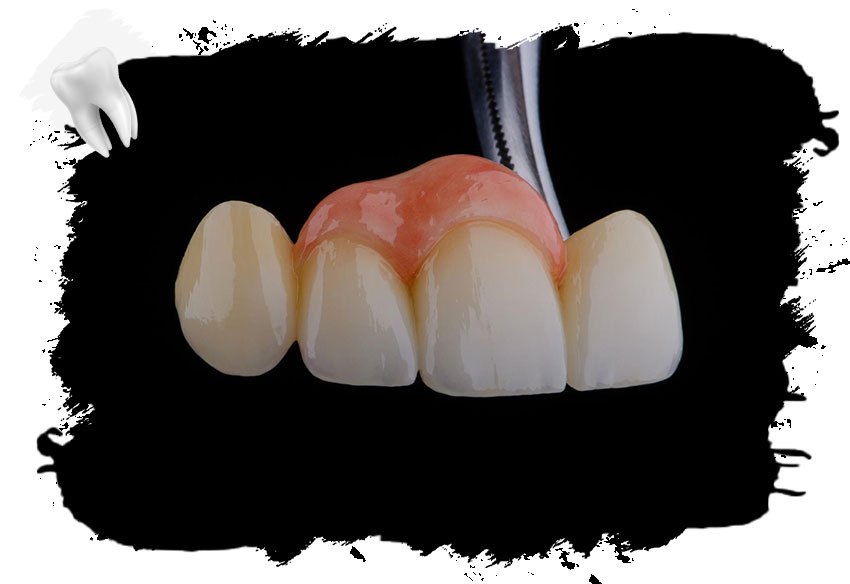 Diş Köprüsü Nedir?