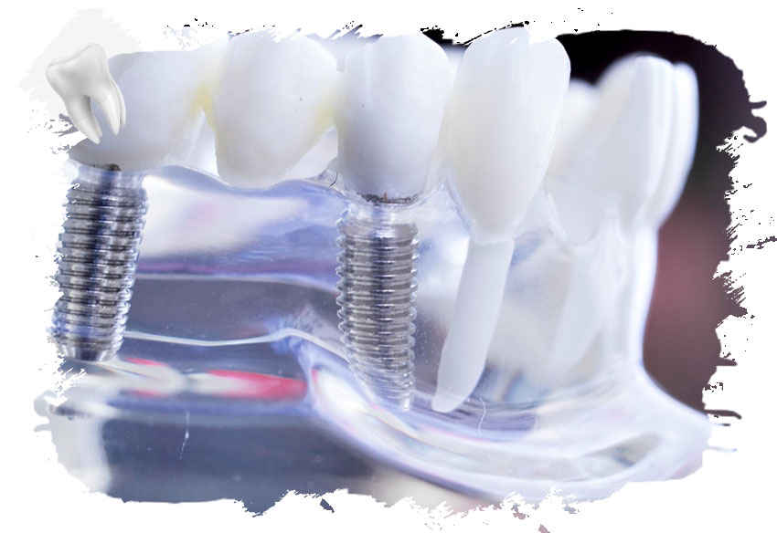 Türkiye’de 1 Günde İmplant