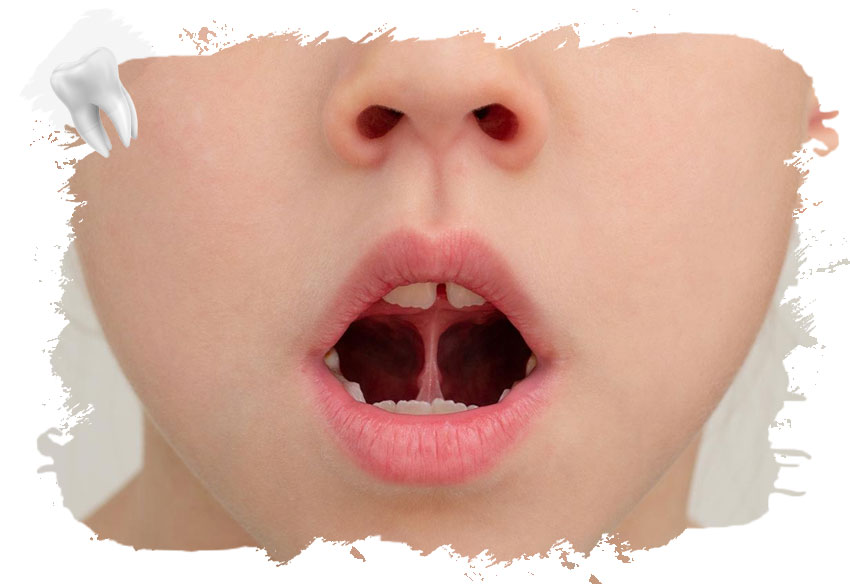 Çocuklarda Dil Bağı