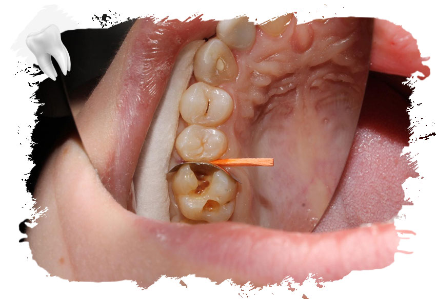 Dişte Lezyon Nedir?