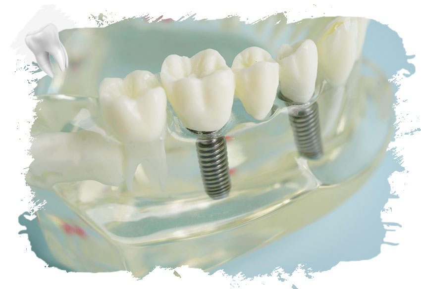 İmplant Tedavisinde Kullanılan Yöntemler