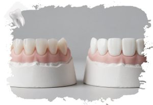 Two dental models: natural-looking porcelain veneers next to bulky, overly white crowns